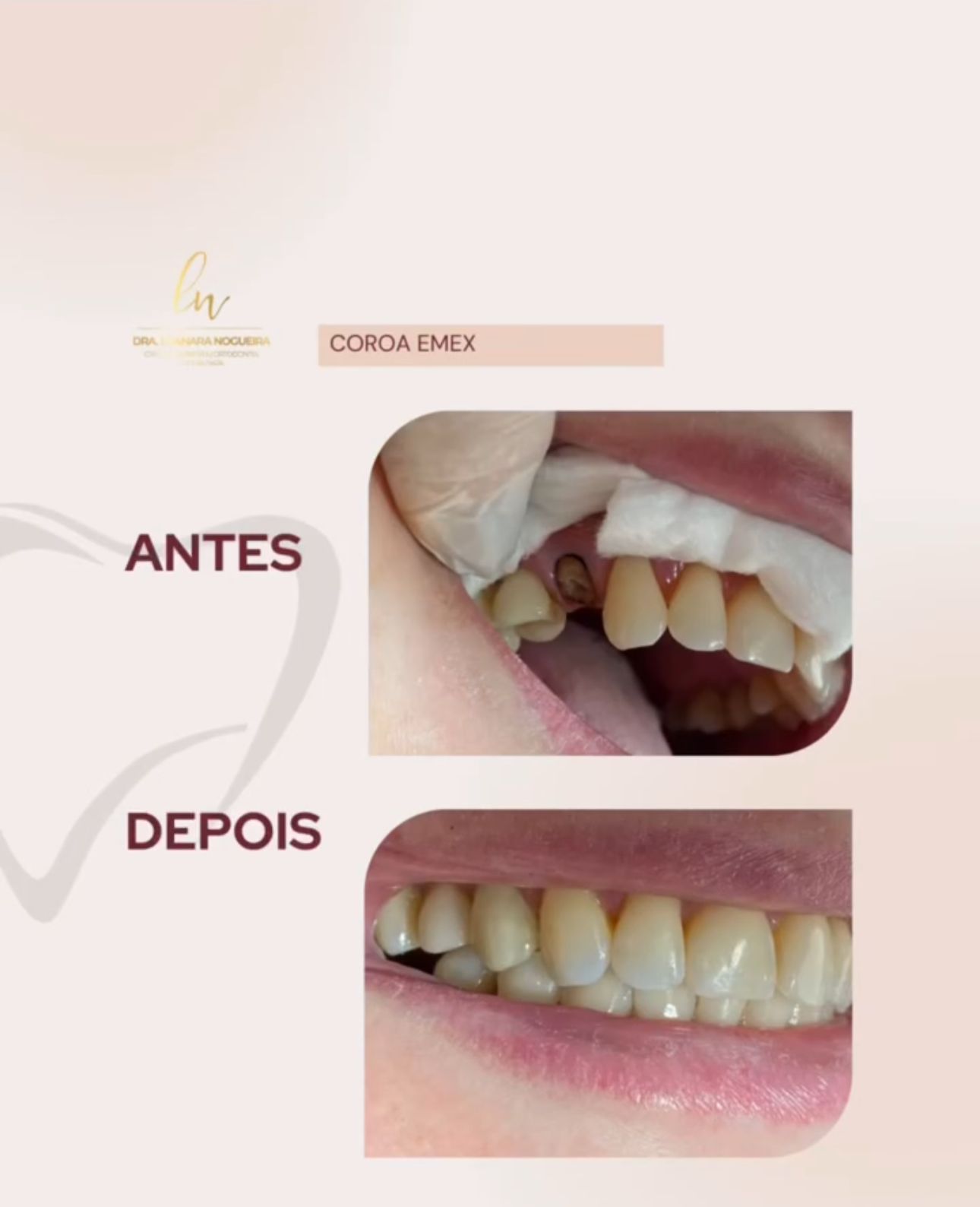 Reabilitação com Coroa E.max